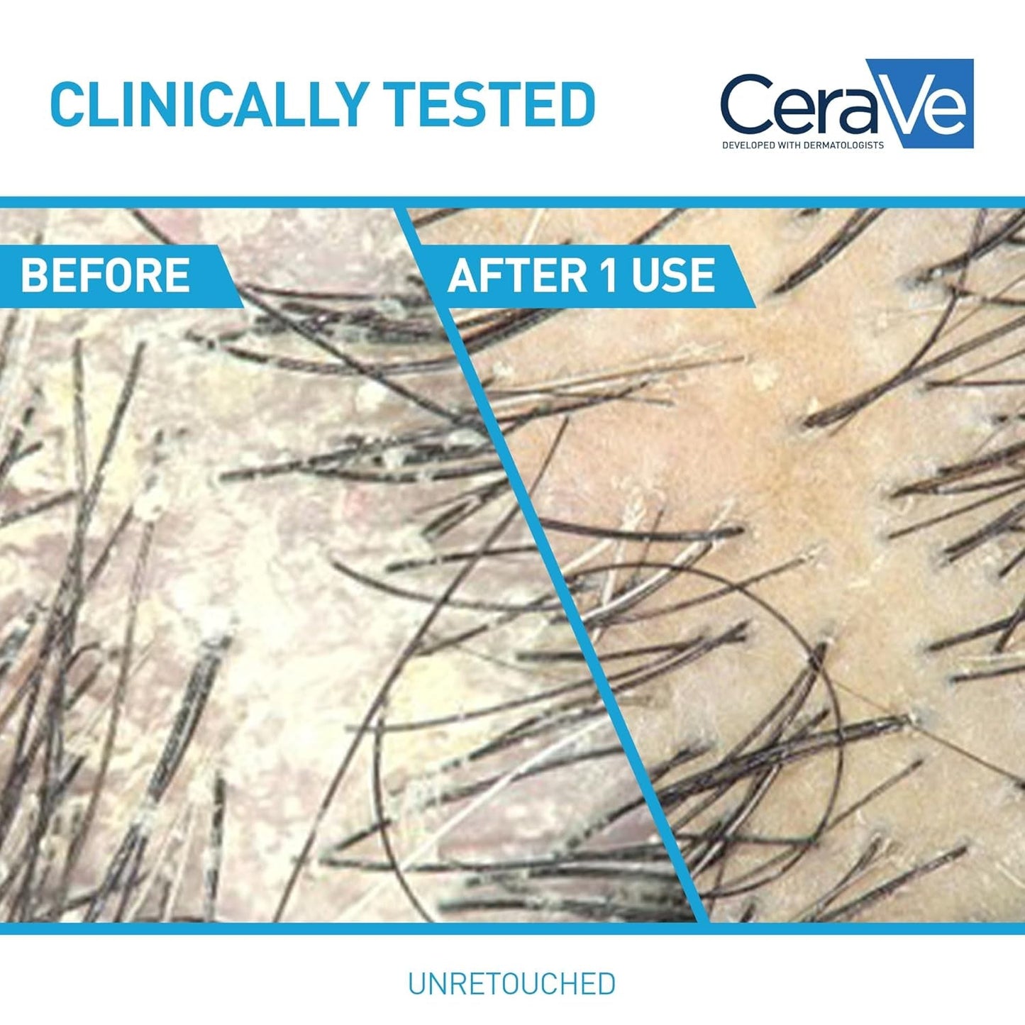 Hydrating anti Dandruff Shampoo, 1% Pyrithione Zinc Dandruff Treatment with Ceramides, Niacinamide & Hyaluronic Acid, Helps Eliminate Flakes & Provides Itchy Scalp Relief, Sulfate Free, 12 Oz